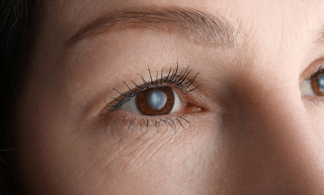 Cirurgia para Glaucoma em Campinas