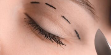 Blefaroplastia: O que é, como é feita e quem pode fazer – Seu guia completo sobre plástica ocular