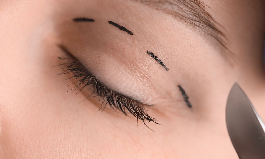 Blefaroplastia: O que é, como é feita e quem pode fazer