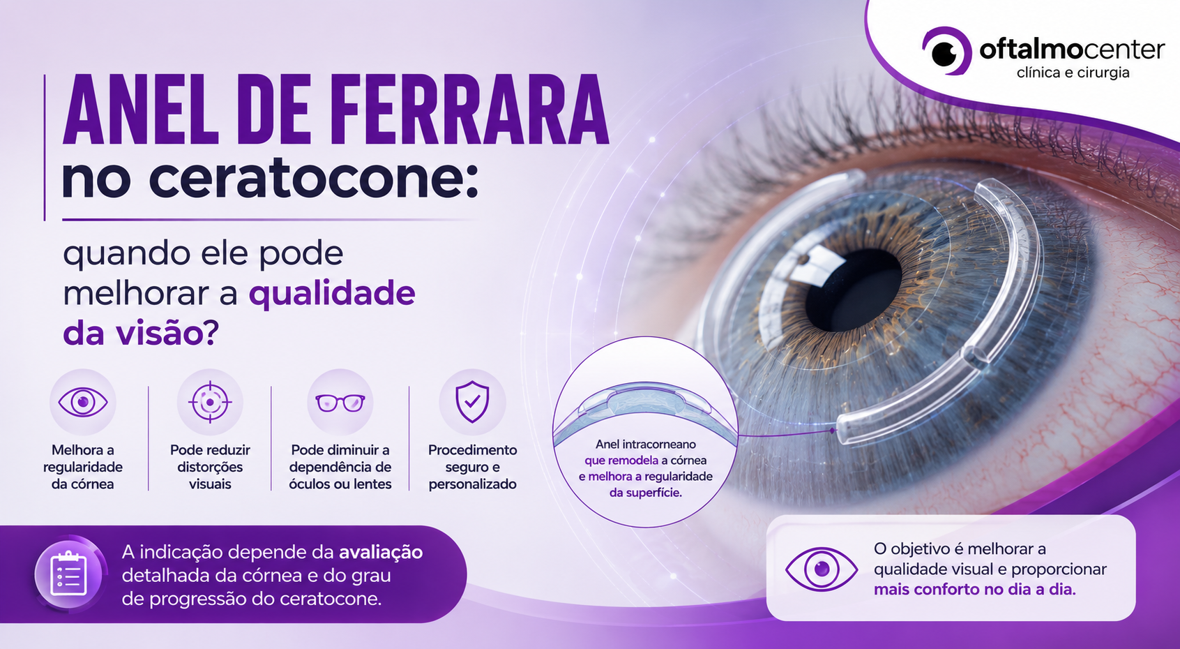 Anel de Ferrara no ceratocone: quando ele pode melhorar a qualidade da visão?